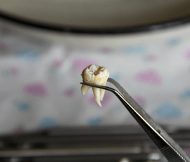 Cirugías de tercer molar